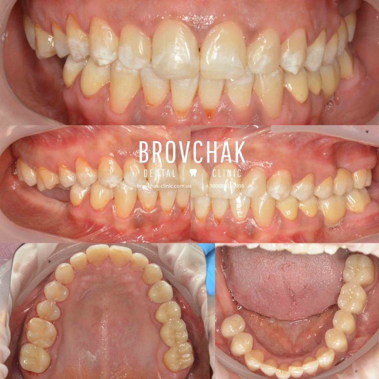 posle-lechenia-zubov