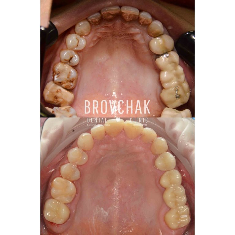 Верх до-після