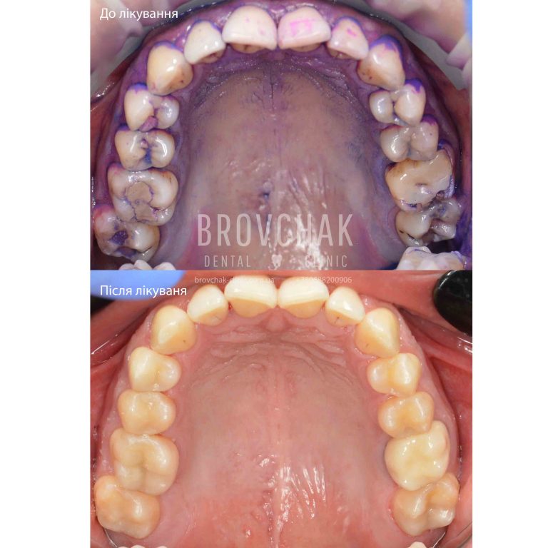 Лапа до після верх 1