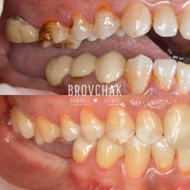 Права стор до після