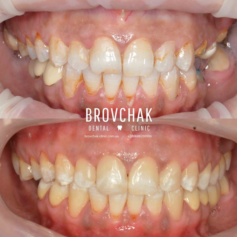 Фронт до після лікув