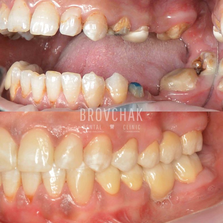 ліва стор до після