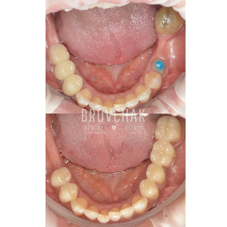 низ до після