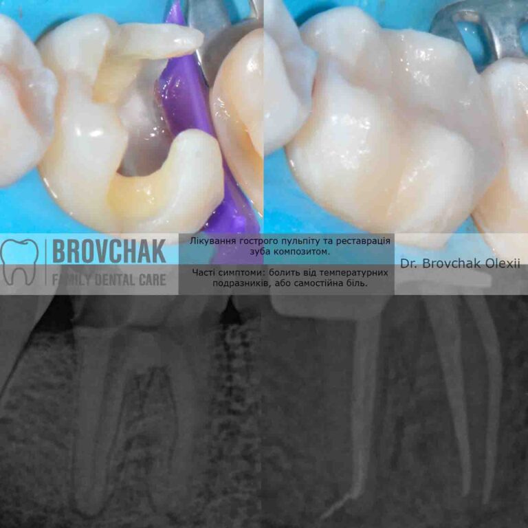 Яковцев ендозжат1