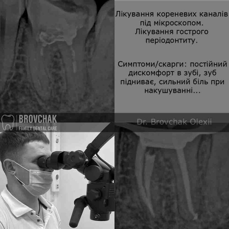 пишненко лікування кореневих каналів psd